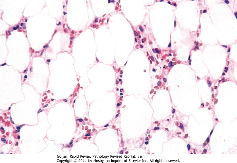 синдромы апластической анемии. апластические анемии картина крови. апластическая анемия костный мозг. апластическая анемия фанкони. апластическая анемия сверхтяжелая форма.