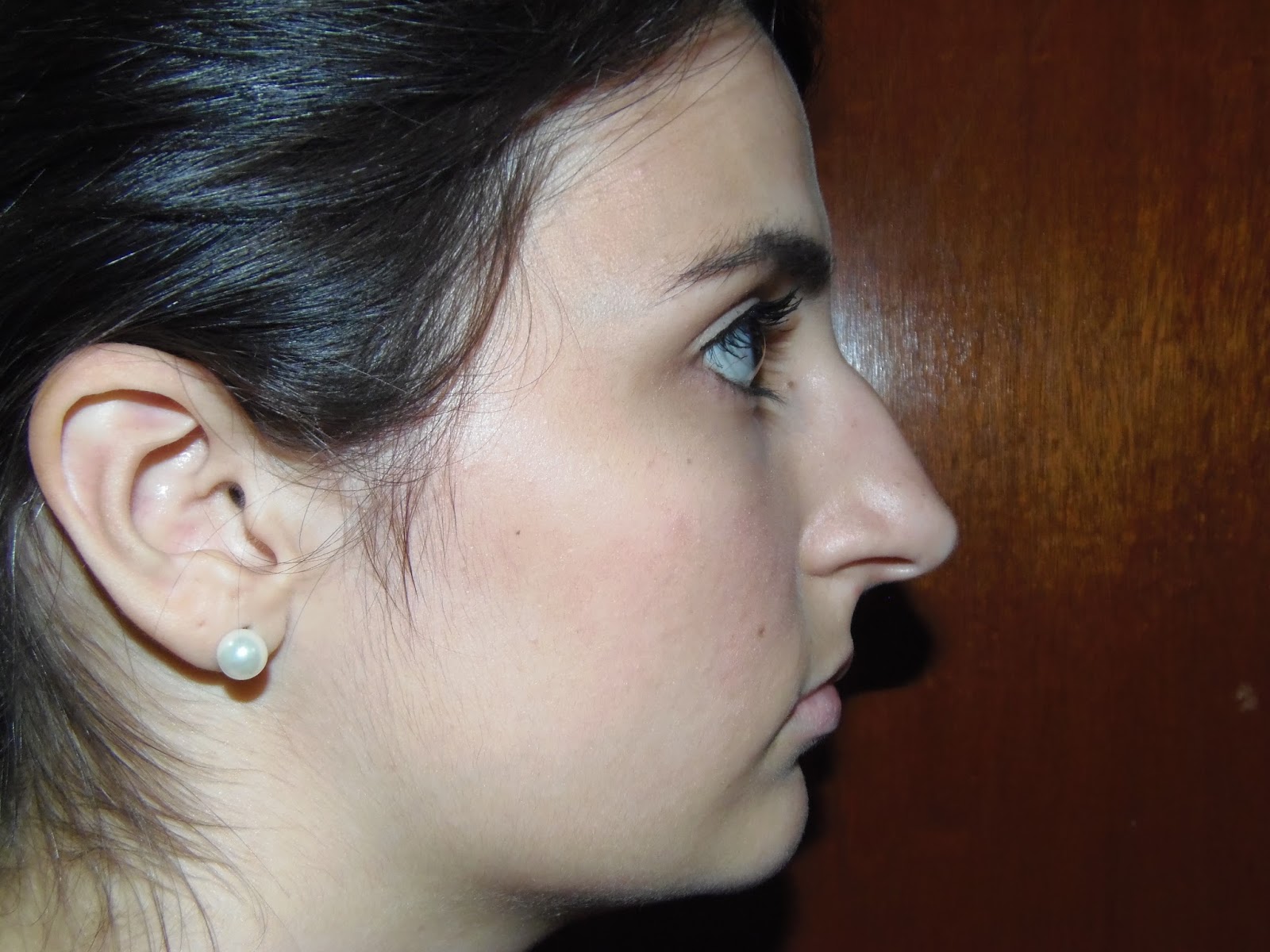 Como era o meu nariz antes da operação | Diário Rinoplastia