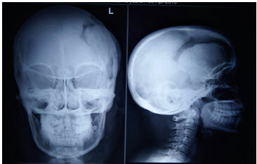 X-ray of the head before excision of tumor
