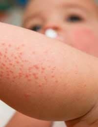 eczema wound care