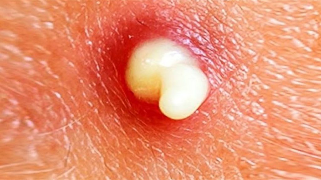 Porque salen espinillas en las axilas_2