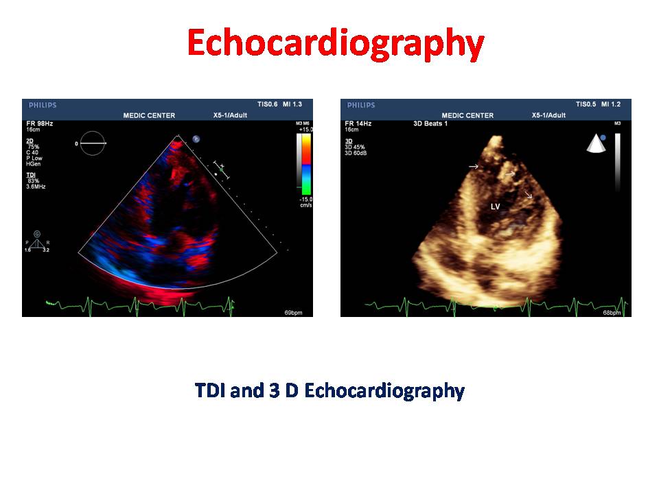 VIETNAMESE MEDIC ULTRASOUND: CASE 205: MEDIC RADIOLOGY CASE 9= Noncompacted Cardiomyopathy on ...