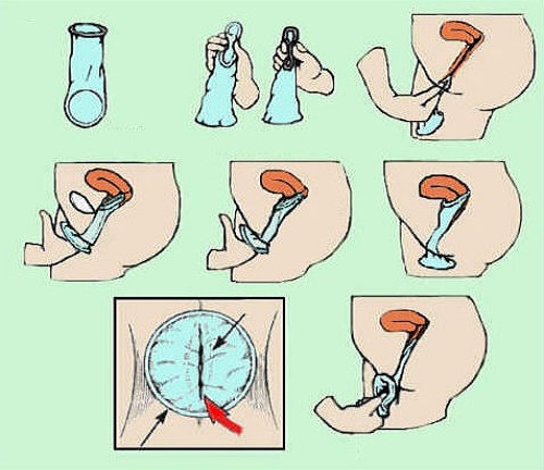 اشكال العضو الانثوي للمتزوجات فقط ماذا تعرفين عن الواقي الأنثوي ؟ - أنت أجمل
