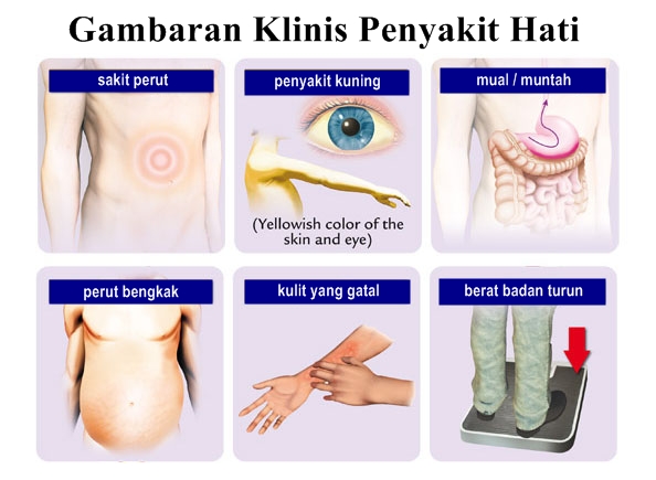 Mengetahui Gambaran Klinis Penyakit Hati | Apotek Tradisional