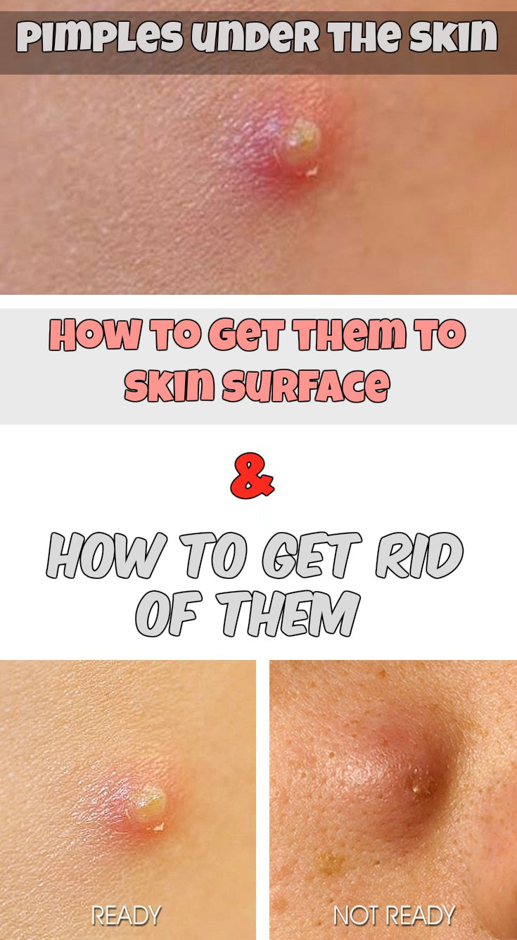 Pimples Under The Skin How To Get Them To Skin Surface And How To Get