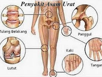 Ciri Asam Urat Berlebih