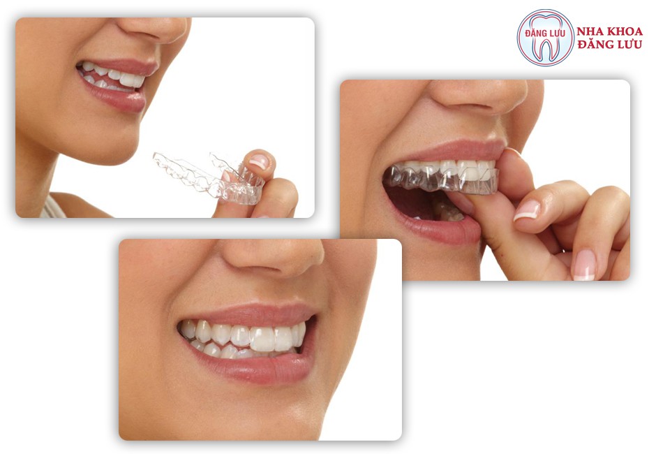 Niềng răng invisalign