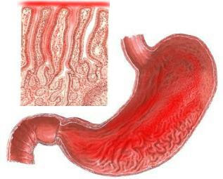 Nursing Diagnosis Imbalanced Nutrition: Less Than Body Requirements of Gastritis