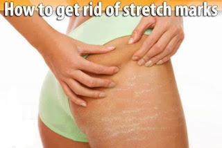 How to remove Stretch Marks in Hindi/Urdu. How to remove Stretch Marks in Hindi/Urdu.