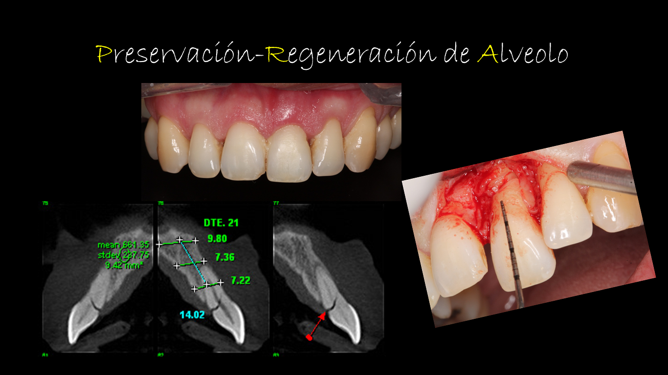 Exodoncia Con Preservacion De Alveolo Previo A La Fijacion De Implante exodoncia-con-preservacion-de-alveolo-previo-a-la-fijacion-de-implante