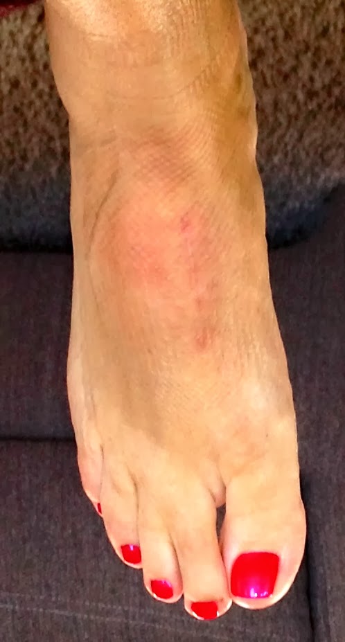 After LisFranc Surgery