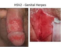 obat herpes buatan sendiri