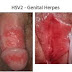 obat herpes agar cepat sembuh