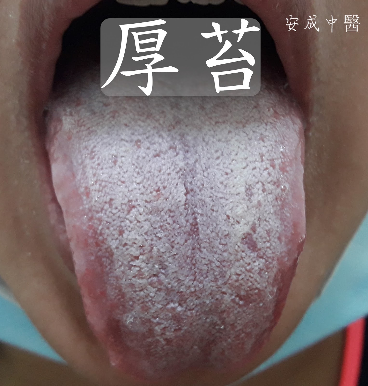 舌苔白腻是怎么回事如何调理（为什么舌苔变白了？和这5个原因有关，予以重视） | 说明书网