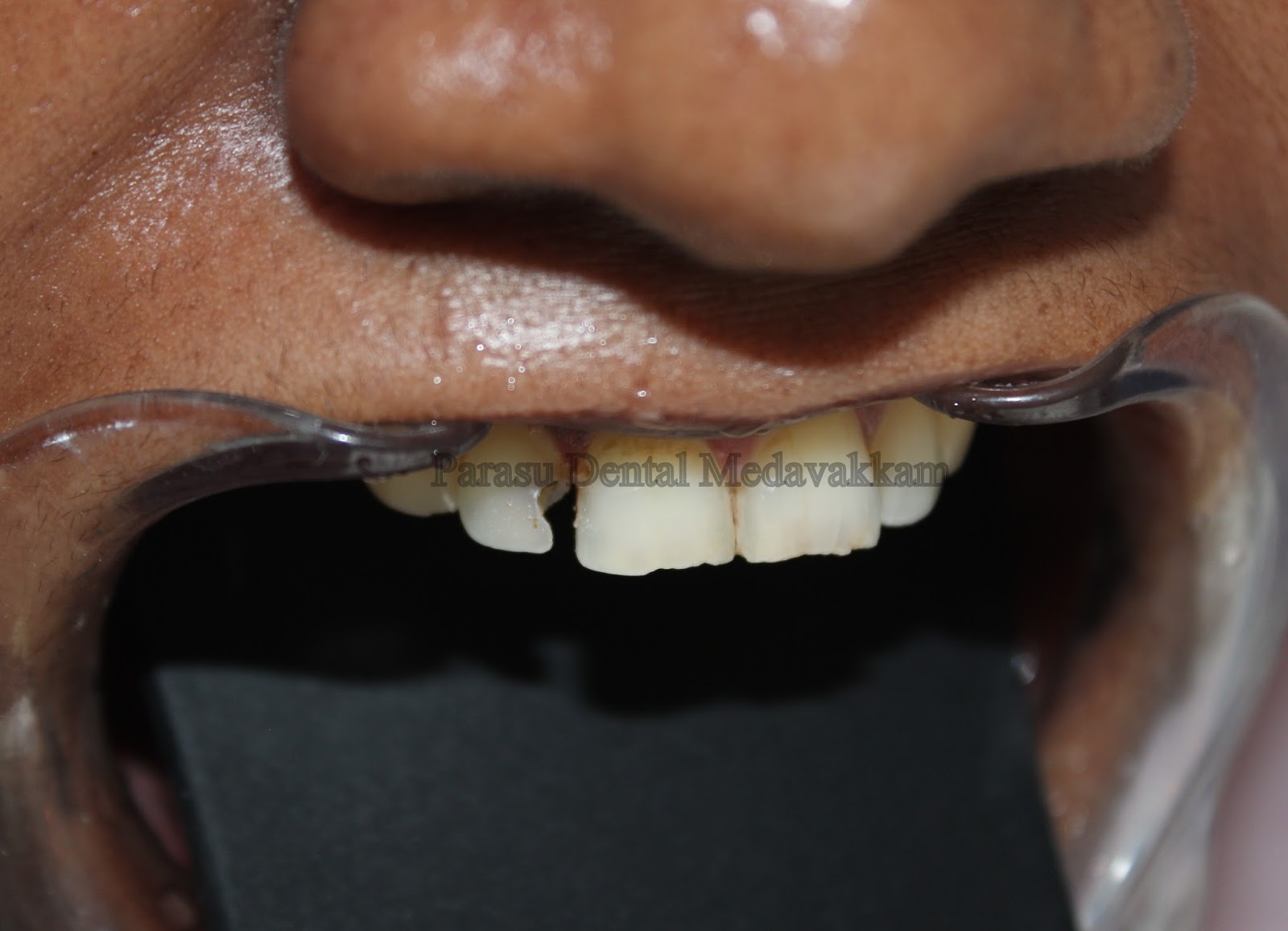 Best Dental Clinic in Chennai Cosmetic treatment in chennai