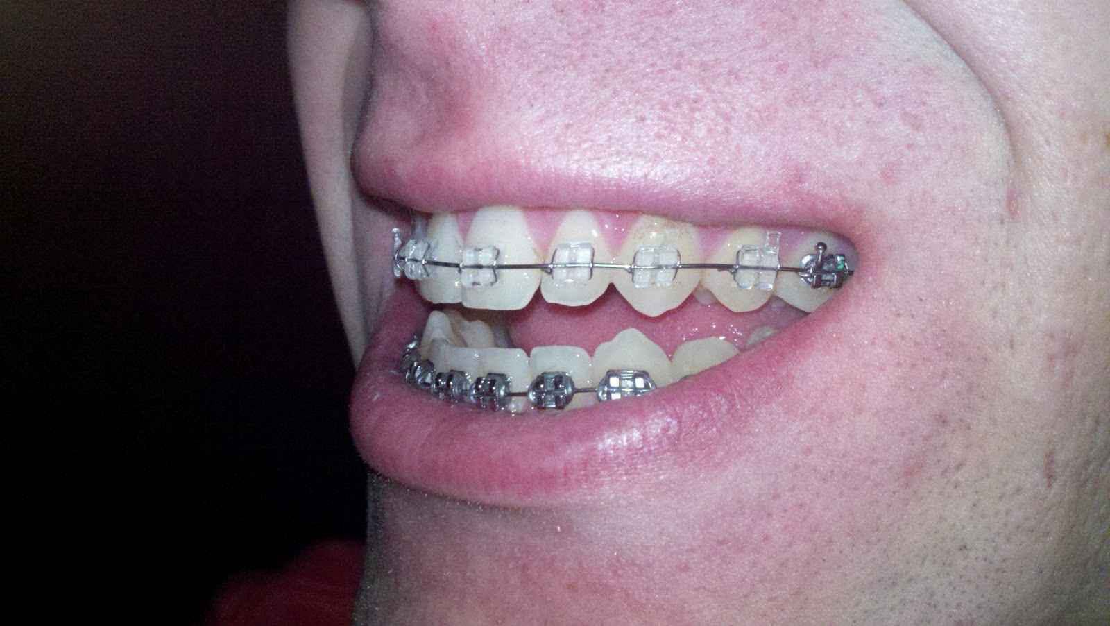 Braces/Open Bite Surgery New pics and quick update