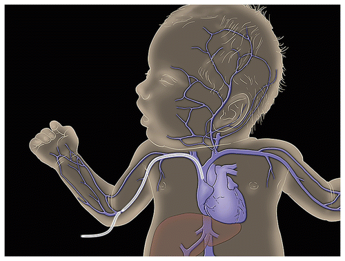 Within Pediatrics: It's a Family Matter: Learning about PICC Lines and