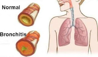 Natural Remedy for Bronchitis, a Natural Way to Cure Bronchitis