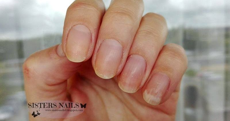 Sisters Nails Moja Walka Z Onycholiza
