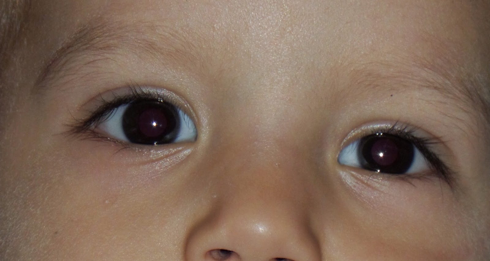 Şaşı Bebek 21 AYLIK TEOMAN�IN AMELİYAT SONRASI 3. MUAYENESİ