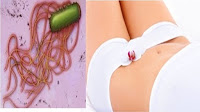 Cara Tepat Mengobati Vaginosis Bakterialis