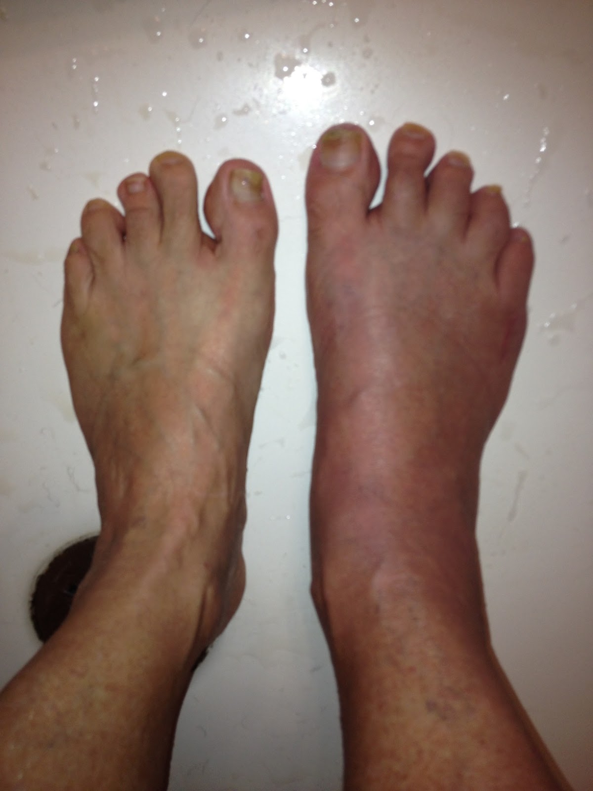 Hurry Slowly . . . but Hurry! Update 128 What the F&K is GOUT?