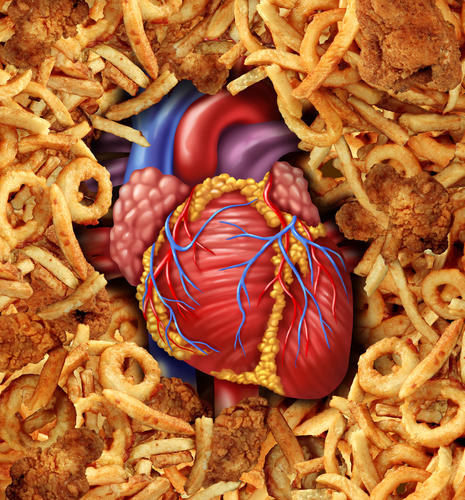 Sports And ACL Injuries 10 Worst Foods For Your Heart Sports And ACL Injuries 10 Worst Foods For Your Heart