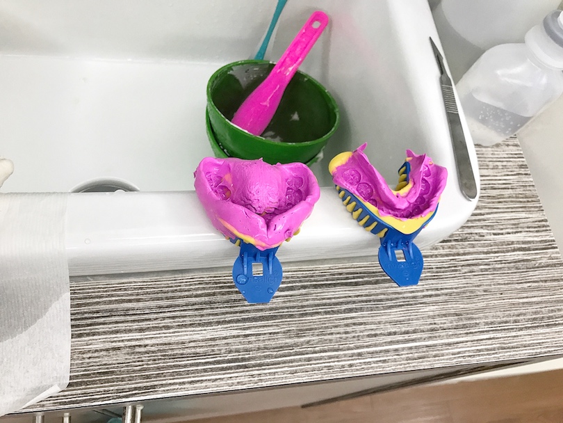 MY BRACES STORY 6 Take off braces, Retainer Mold , Invisalign