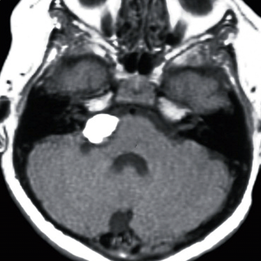 Intracranial lipoma