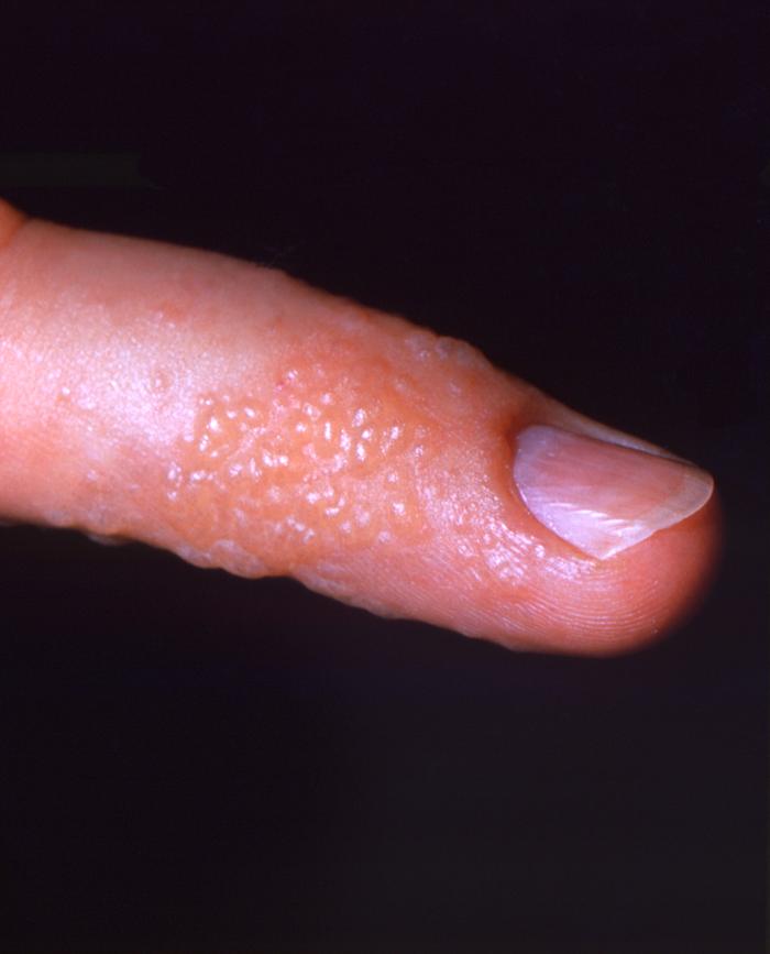 herpes on your finger