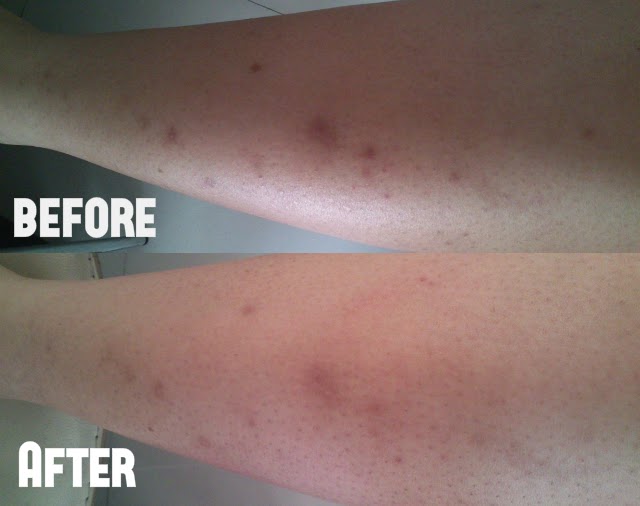 egyptian magic rosacea