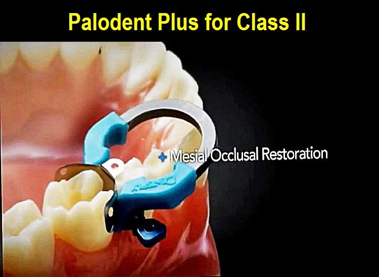 PALODENT PLUS Sectional Matrix System for Class II
