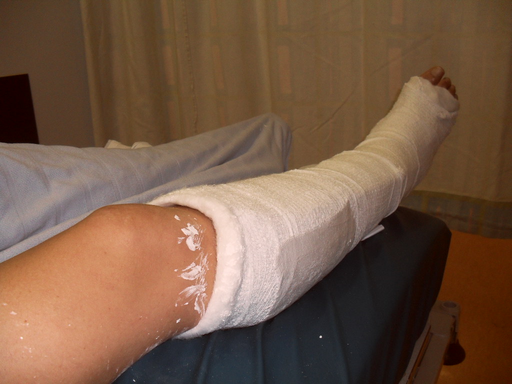 Broken Ankle Being Plastered for 8 week It all started with a night