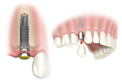 Implantul dentar vs. plombe din amalgam