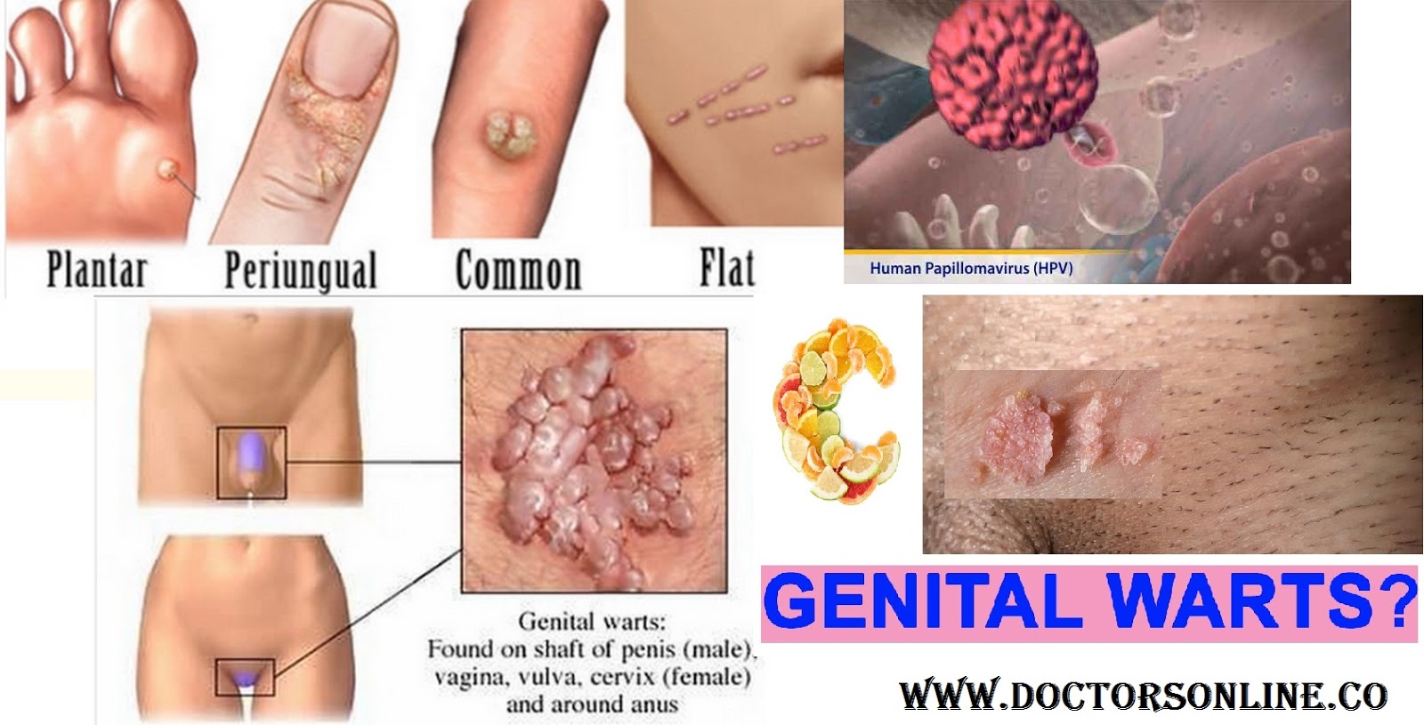 Warts: Pictures, but all warts are caused by human papillomavirus (HPV),) C...