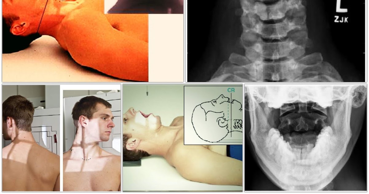 Cervical Spine or Neck Xray Radiography RadTechOnDuty