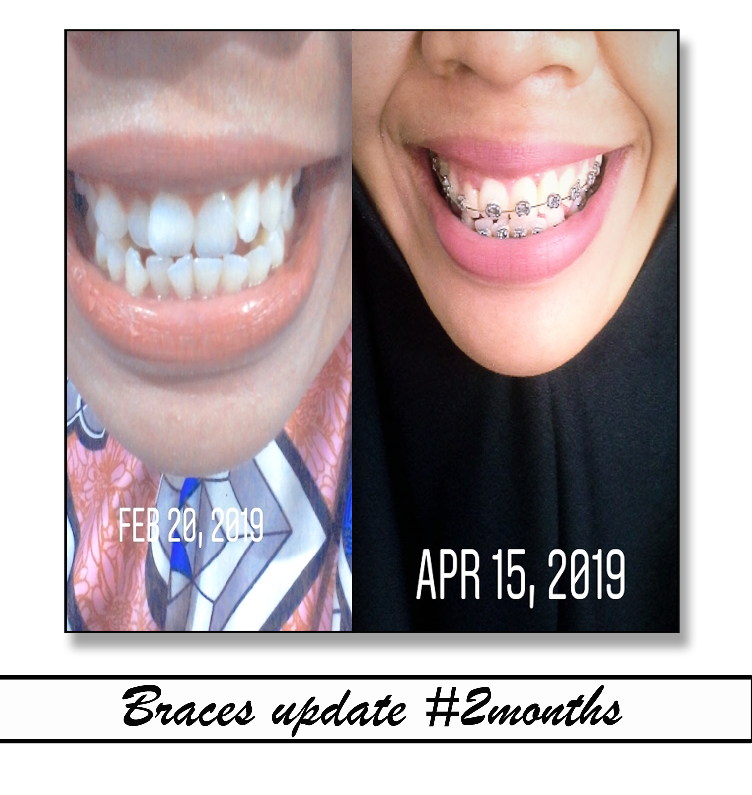 Biaya Pasang Behel Di Rumah Sakit Berbagai Rumah