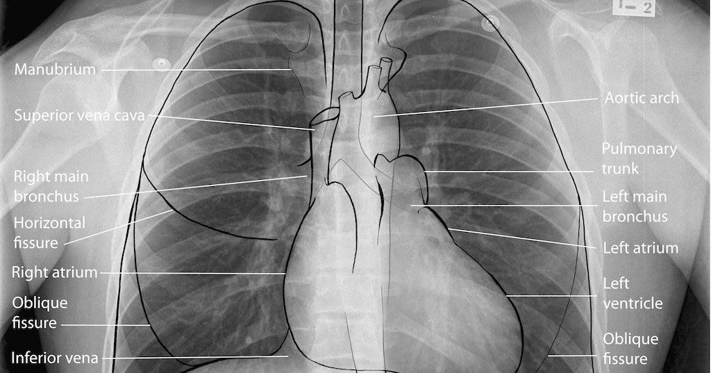 Abcs Of Reading A Chest X Ray How To Read A Chest X R vrogue.co