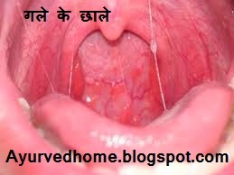 Symptoms of Throat Ulcers and Treatment