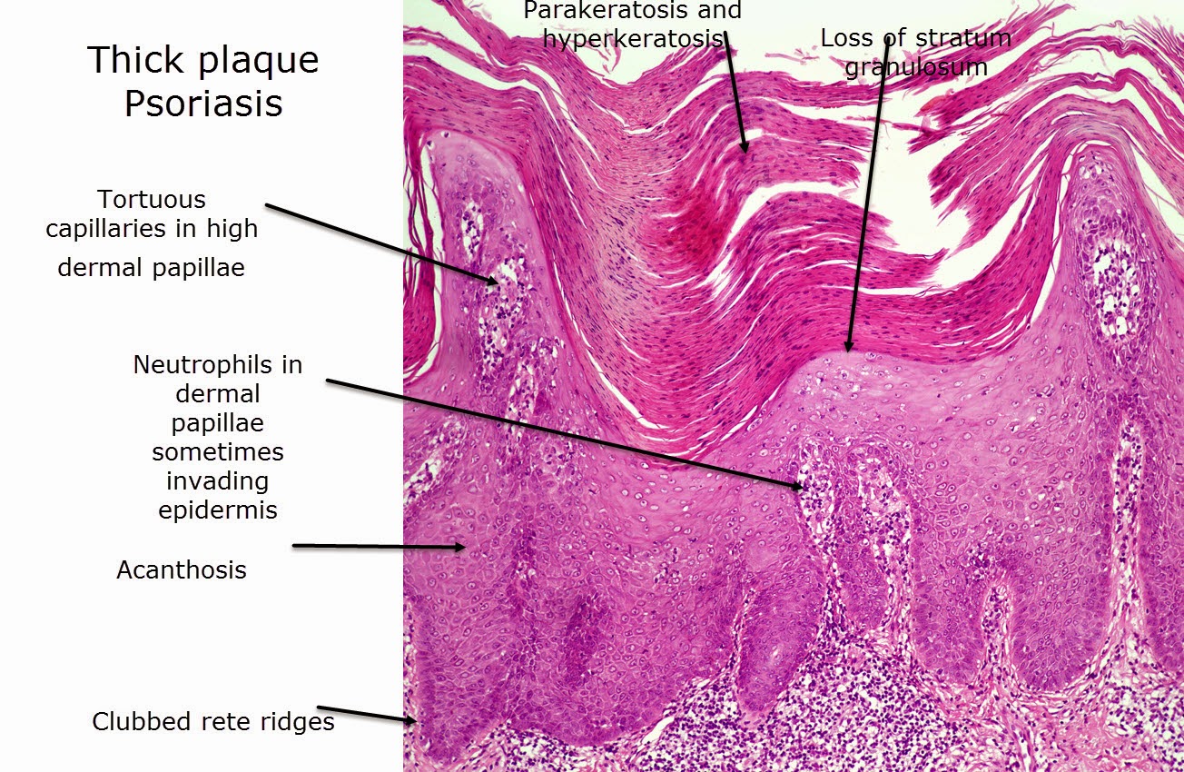 plaque psoriasis histology