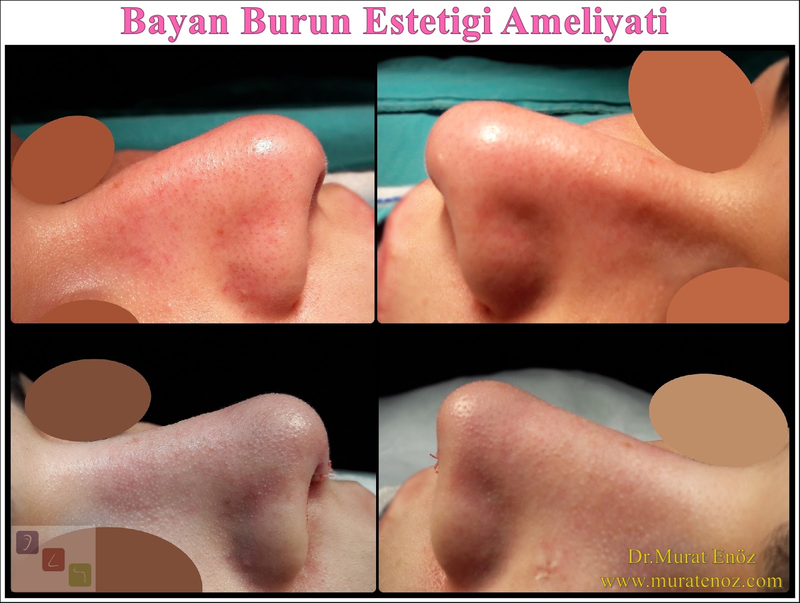 Bayan Burun Estetiği Ameliyatı