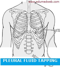 pleural-fluid-tapping