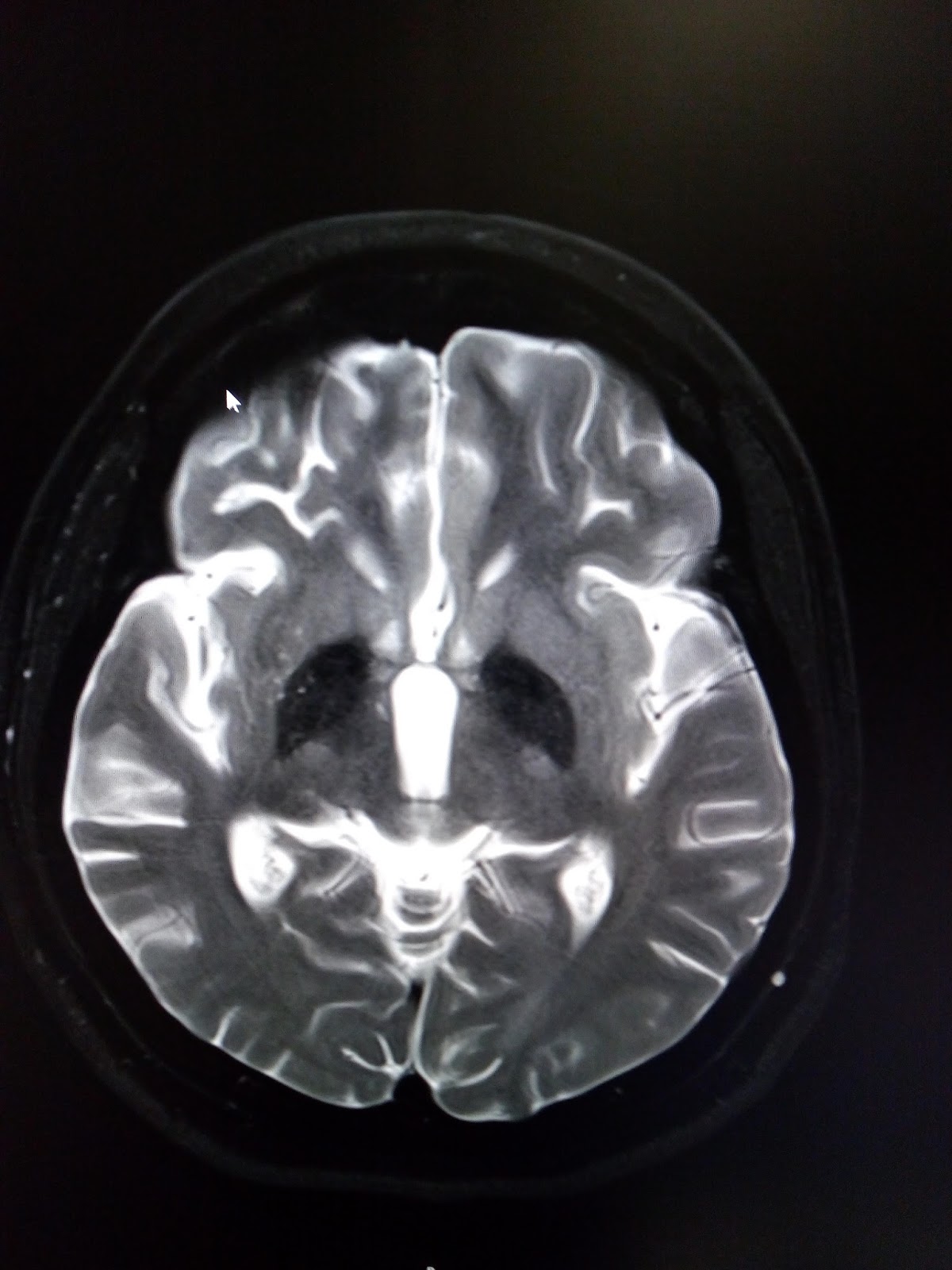 Neurodegeneration with Brain Iron Accumulation (NBIA) MRI Sumer's