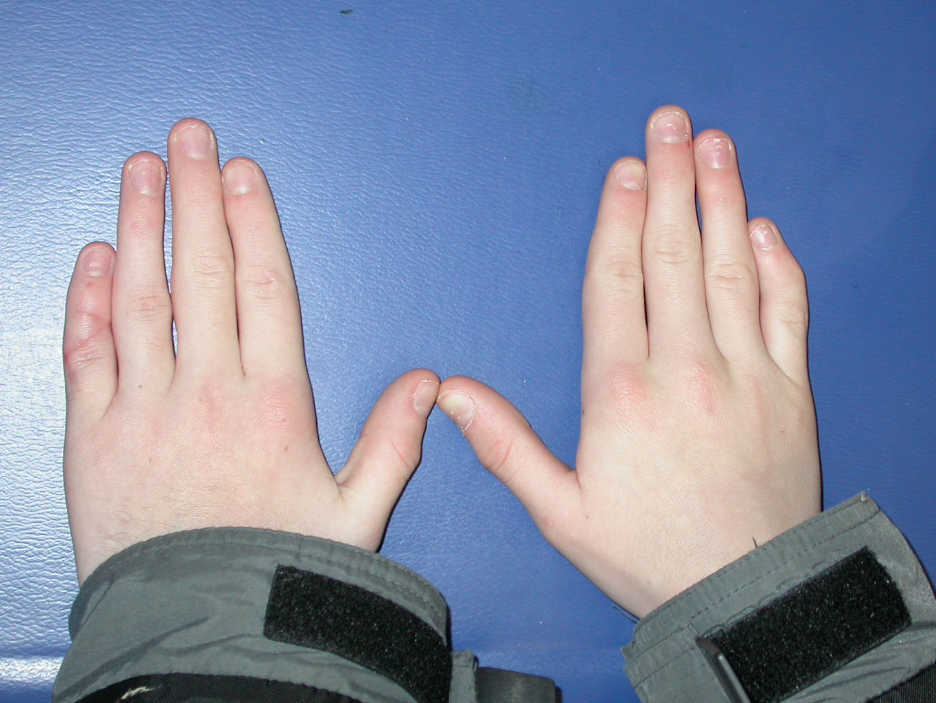 Congenital Hand And Arm Differences July 2012 congenital-hand-and-arm-differences-july-2012