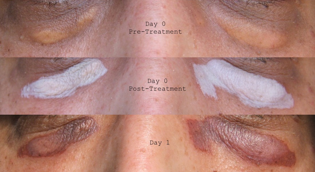 Xanthelasma Treatment Xanthelasma Treatment My Experience of DIY