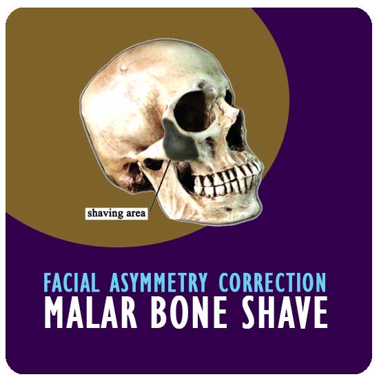 Facial asymmetry correctionMalar bone shave Richardson dental and craniofacial Hospitalposts