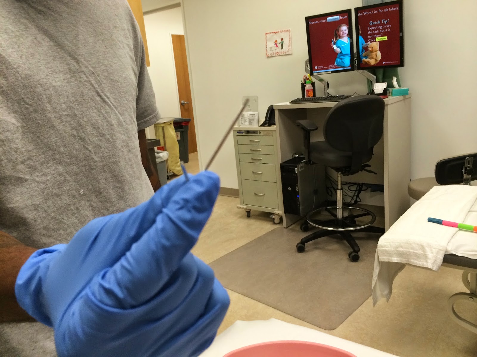 fibular hemimelia leg lengthening Pin Removal and Walking Cast