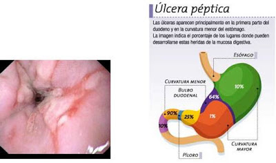 úlcera péptica