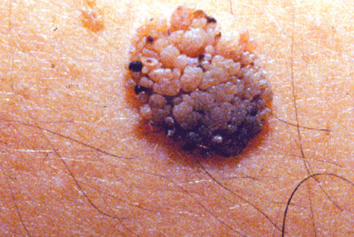 Actinic keratosis - Wikipedia