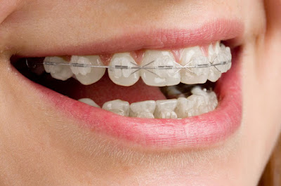 Niềng răng móm có thực sự cần thiết?